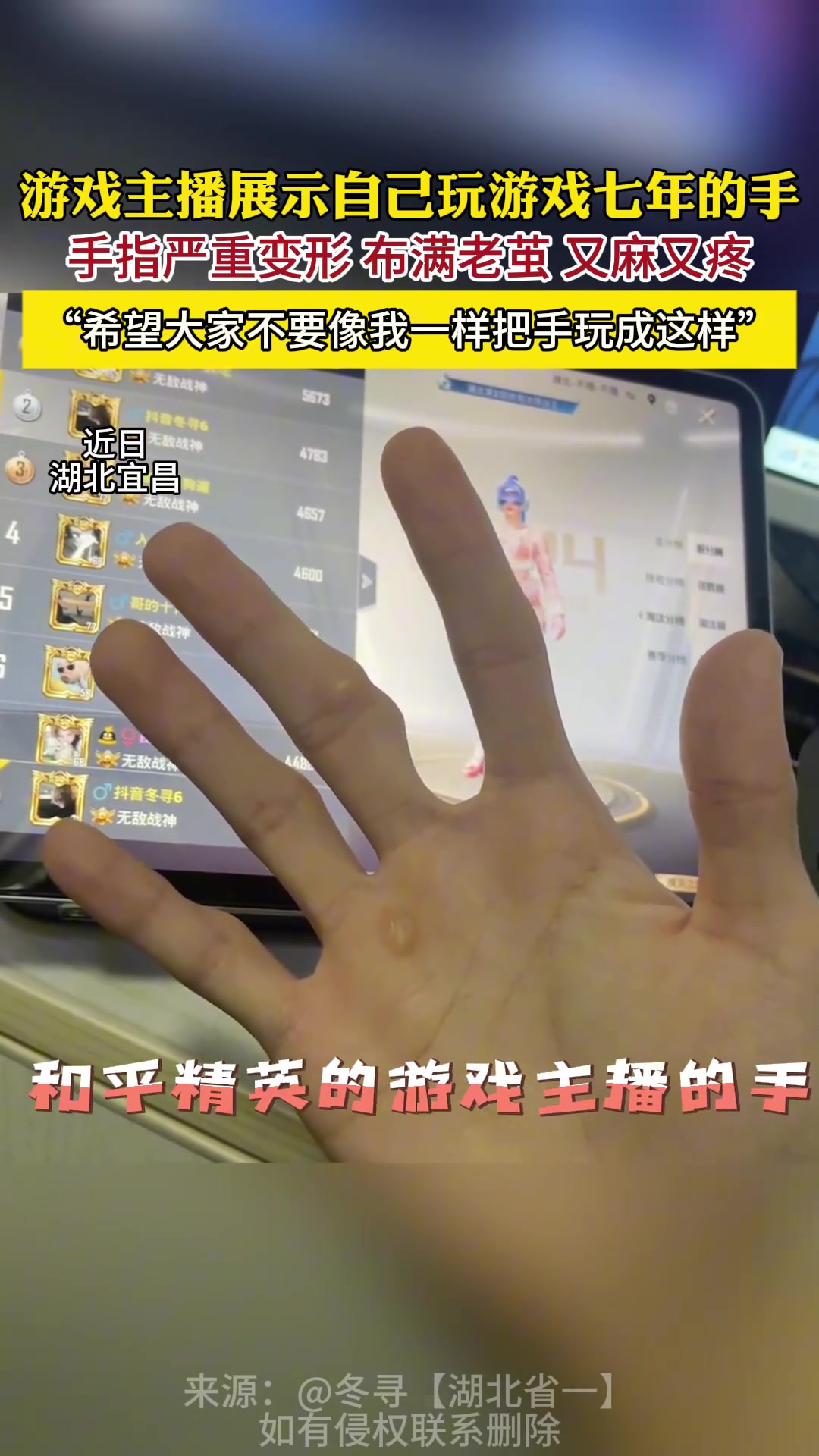 png电子官网游戏主播玩游戏7年手指严重变形：每天固定一个动作十几个小时
